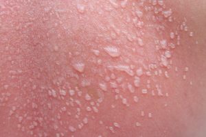 Какие причины возникновения прыщей на лице и теле, их разновидности?