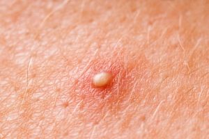 Какие причины возникновения прыщей на лице и теле, их разновидности?