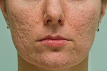 кожа лица в рубцах от прыщей
