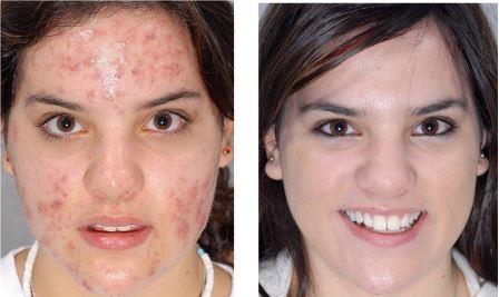 девушка с прыщами на лице и без прыщей