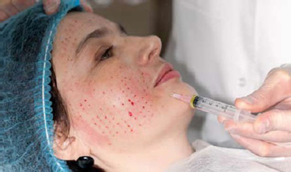 Гиалуроновая кислота. Что выбрать: инъекции, крема или таблетки?