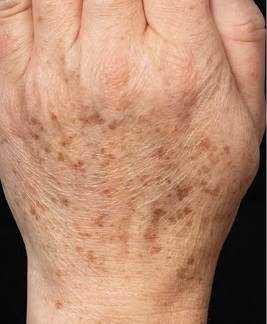 Причины появления пигментных пятен на коже