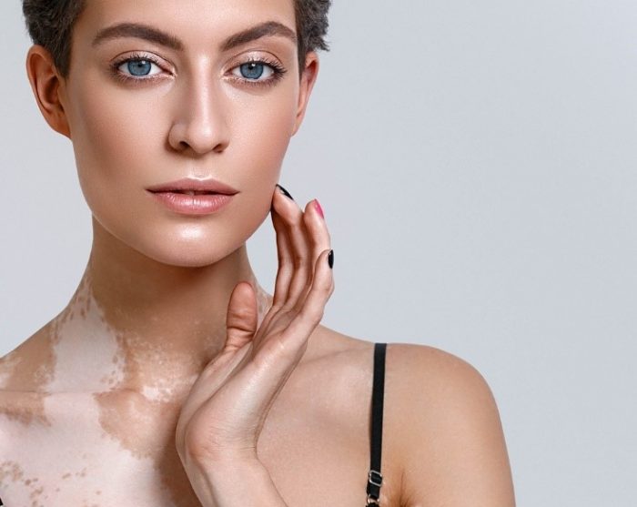 Причины появления пигментных пятен на коже